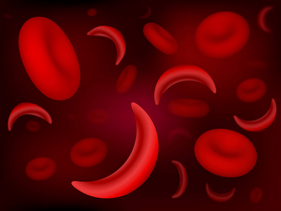 Diagnóstico de la Sicklemia en Cuba, un programa de referencia internacional Diagnóstico de la Sicklemia en Cuba, un programa de referencia internacional