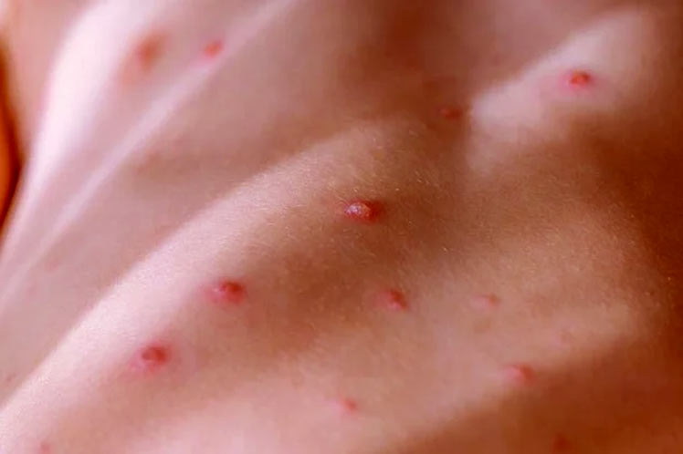 Redobla Cuba vigilancia epidemiológica ante viruela símica Redobla Cuba vigilancia epidemiológica ante viruela símica